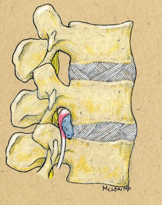 Picture of Dr. McLain's illustration of sequestered disc fragment compressing the lumbar spinal nerve and causing radiculopathy