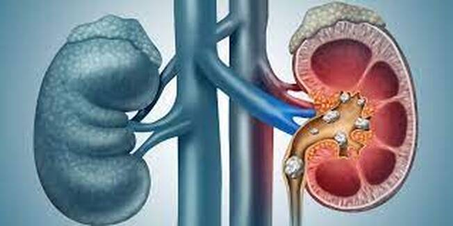 Illustration of kidney stones causing back pain
