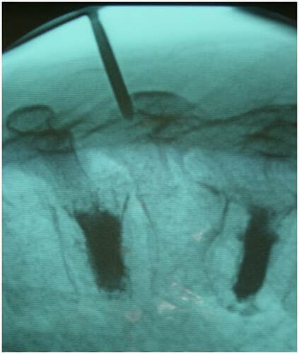 Picture of Patient with multiple myeloma being treated for three adjacent compression fractures