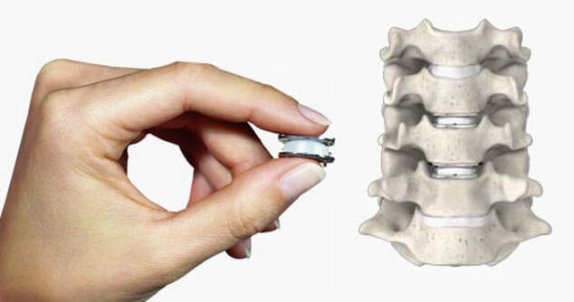 Picture of MobiC artificial disc showing size and placement in the spinePicture