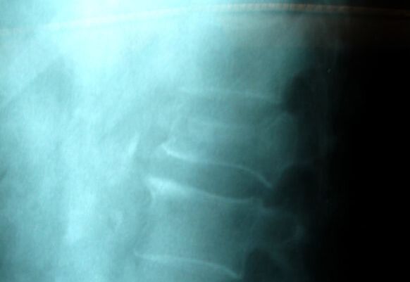 X-ray of vertebral compression fracture