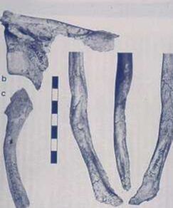 Remnants of the shattered and amputated humerus, an infected clavicle and fractured scapula of Shanidar 1.   Trinkaus, E.: The Shanidar Neanderthals. Academic Press, New York, 1983