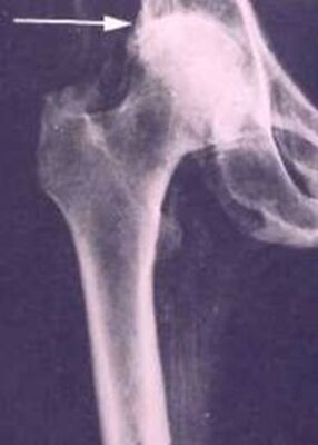 X-ray showing common findings of degenerative joint disease seen today, present in an Egyptian mummy