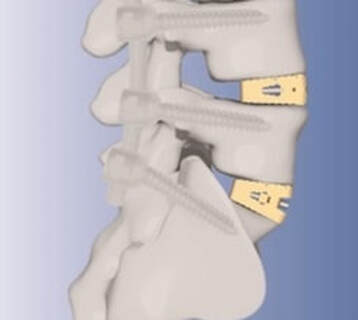 Picture of interbody cages used for spine fusion