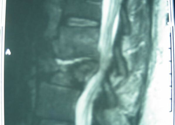 MRI of spinal infection with spinal cord compression