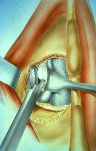 Picture of the nerve protected by a retractor, the disc fragment is removed.