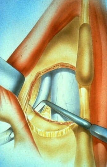 Picture after the disc fragment is removed demonstrating the decompressed nerve free of pressure.