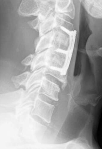X-ray of cervical spine 4 years after patient had a two-level cervical fusion with a plate and screws used for fixation.  the large osteophyte at the level below reveals the severe adjacent level disease.