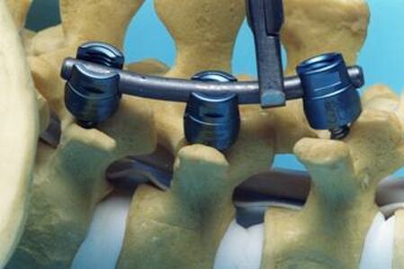 Picture of pedicle screws and rods in spine