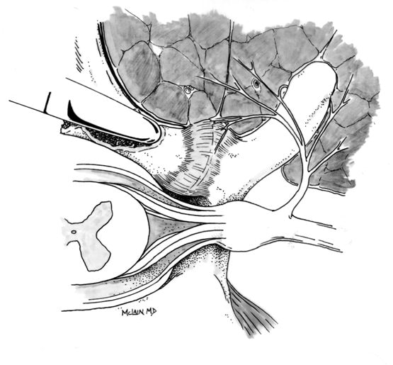 Dr. McLain's drawing of spinal anatomy showing the dorsal root ganglion which is exquisitely sensitive to pressure and inflammation