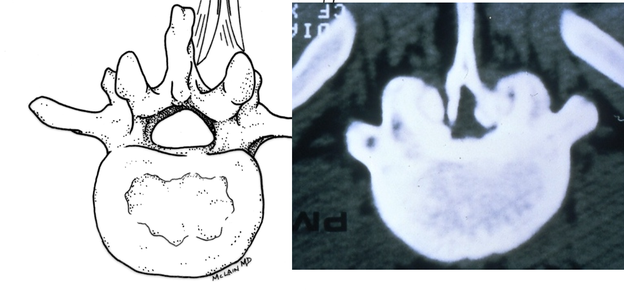 Lumbar spinal stenosis develops over years, reducing the normal spinal canal diameter, seen in the drawing on the left, down to a fraction of what it once was, seen in the CT scan on the right.  (McLain 1995).