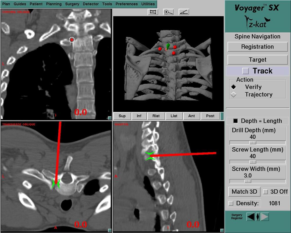Images used for computer assisted removal of a spinal tumor