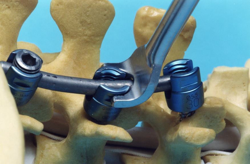 Picture of pedicle screws and rods being placed in a lumbar spine model