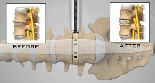 XLIF Lumbar fusion illustration showing implant placement (Nuvasive Spine)